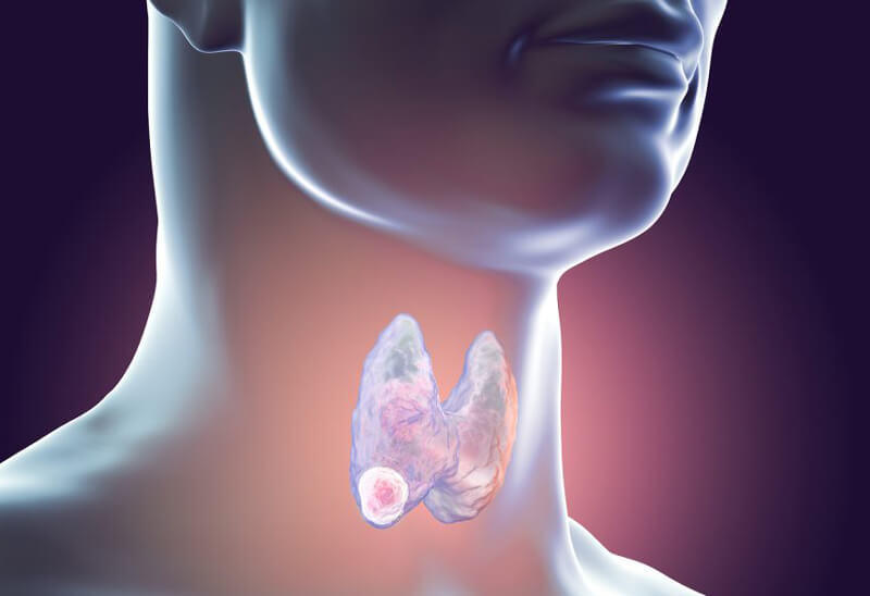 Щитовидная железа: Орган недовольства