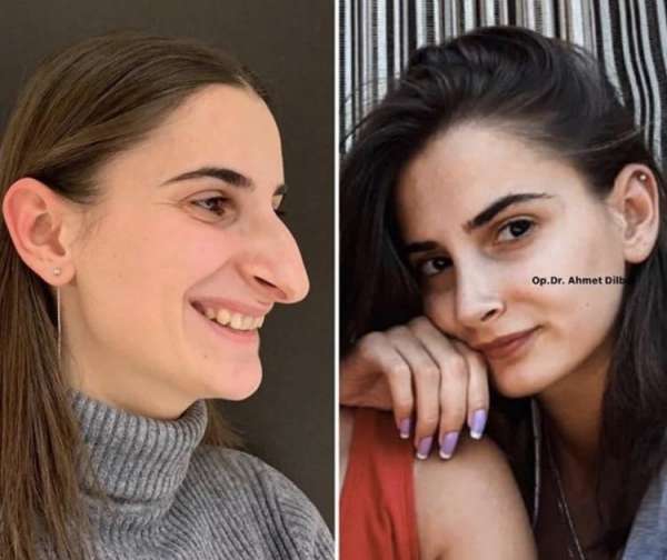 5 фотографий обычных девушек, которые преобразились после ринопластики